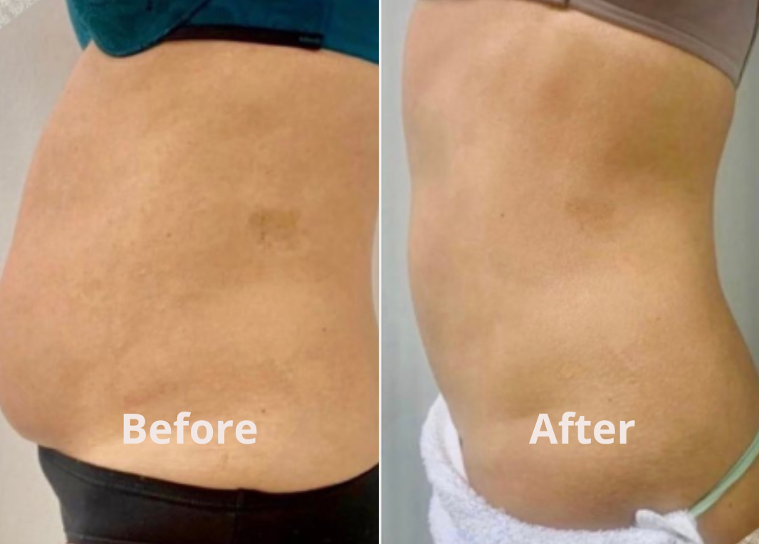 Lipocavitation result