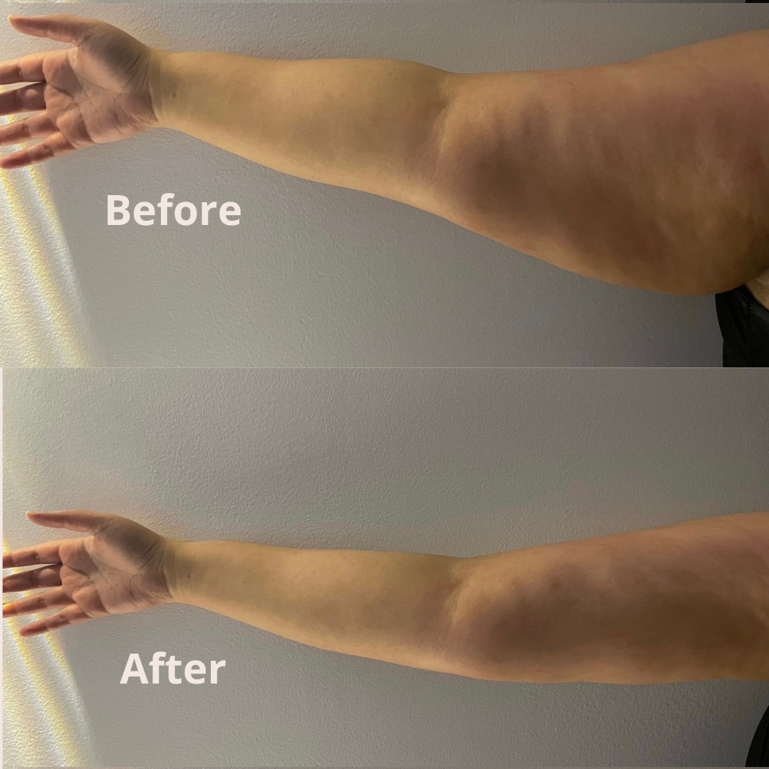 Lipocavitation result