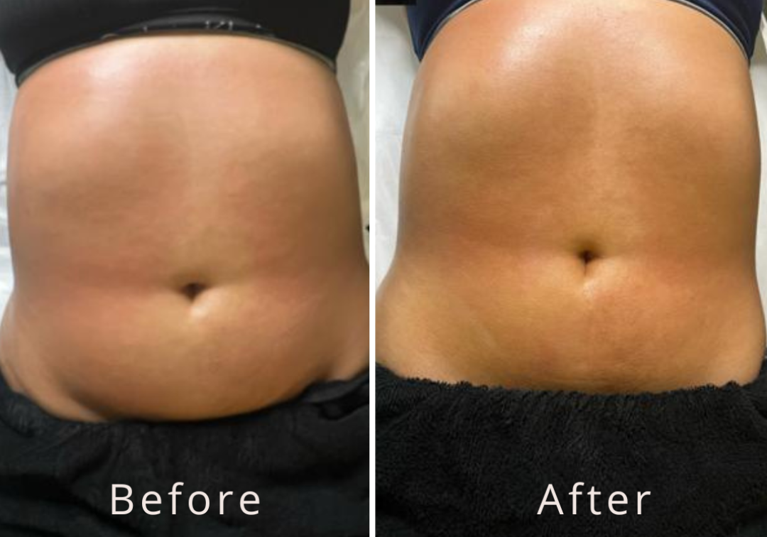 Lipocavitation result
