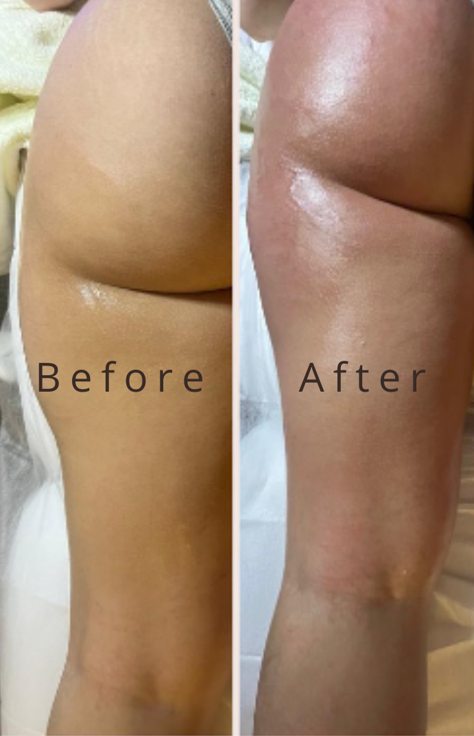 Lipocavitation result