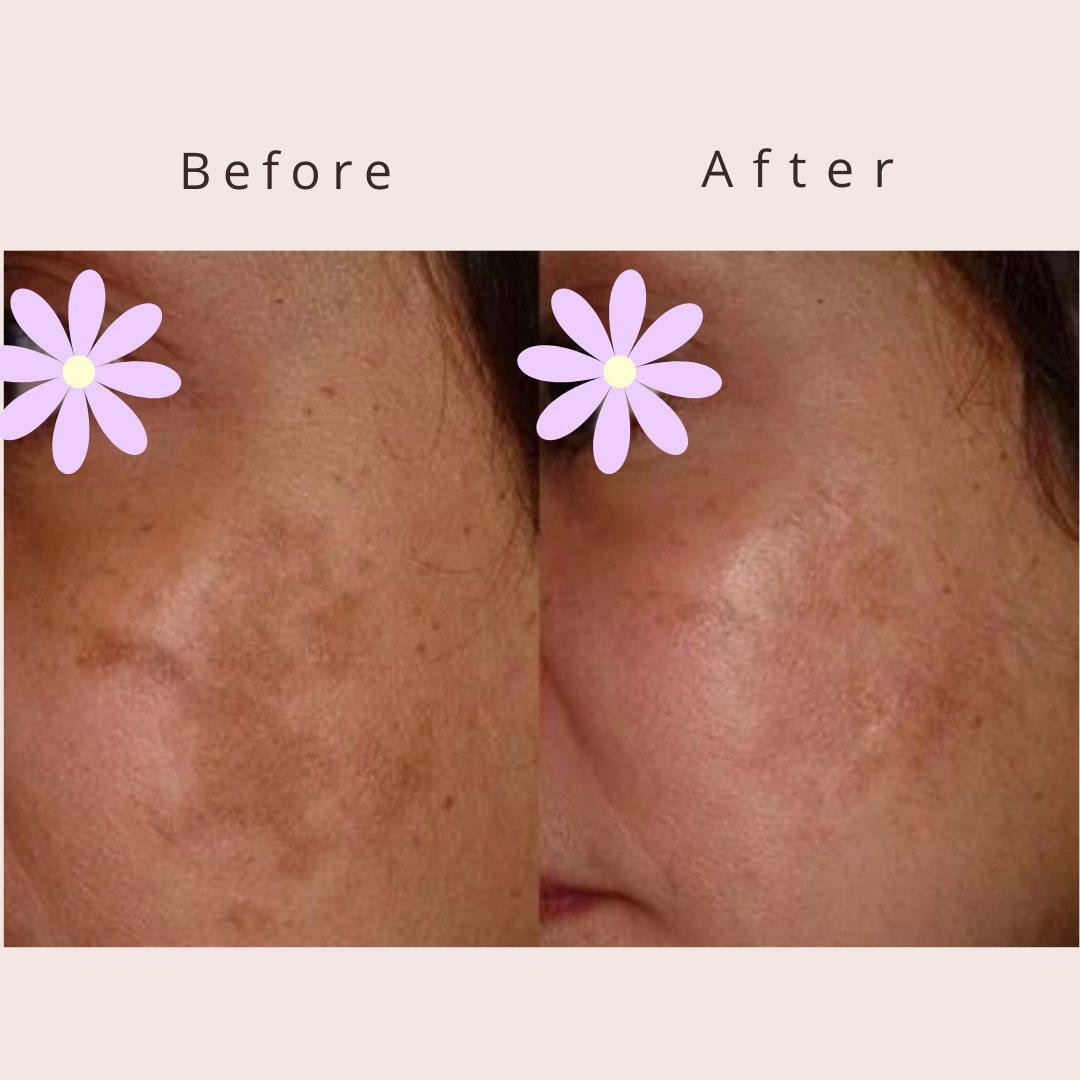 Fractional microneedling RF result