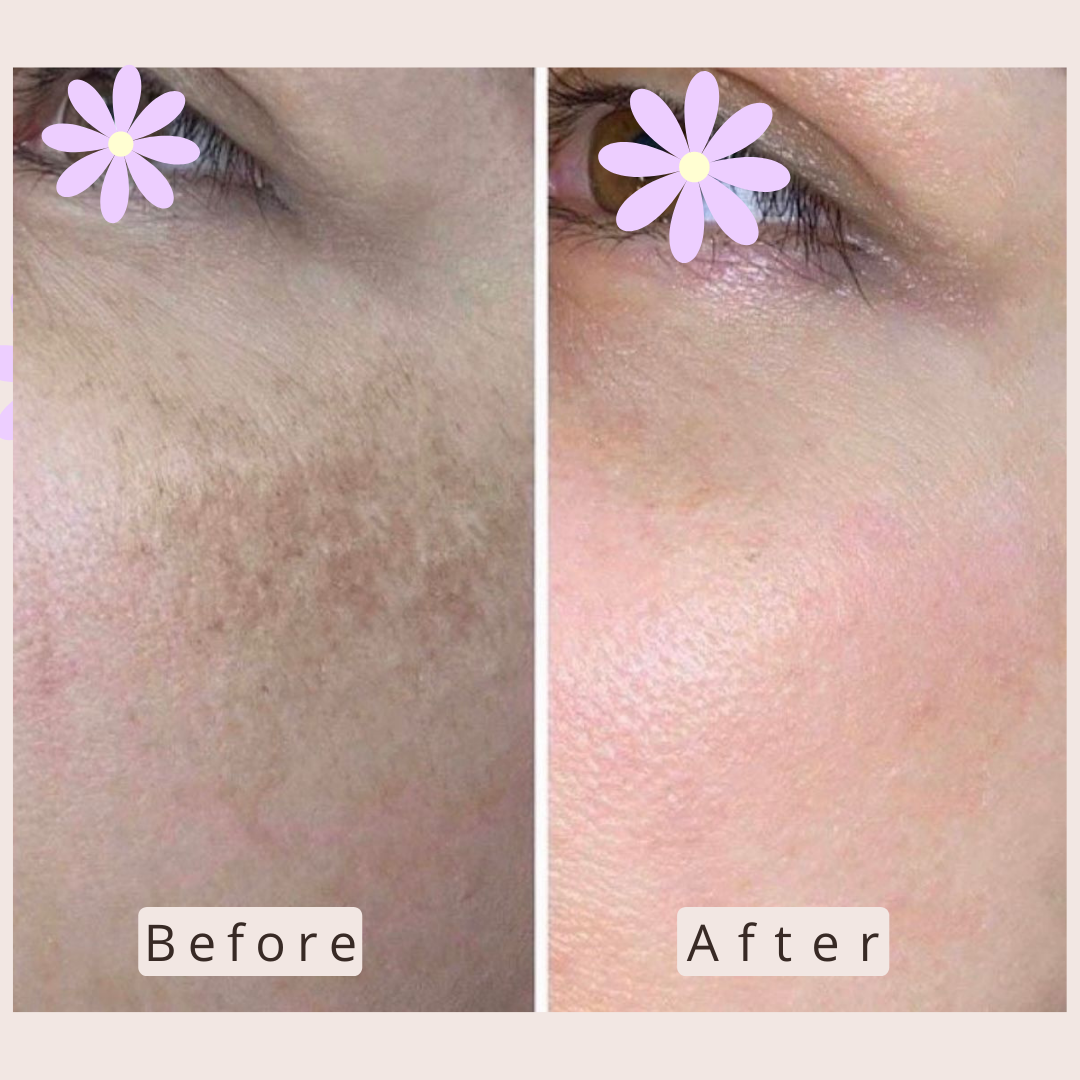 Microneedling and chemical peeling result