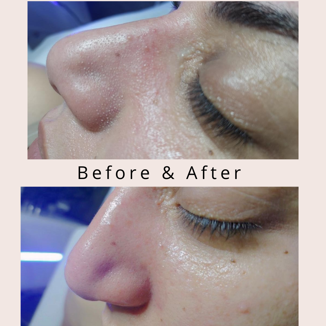 Hydrafacial result