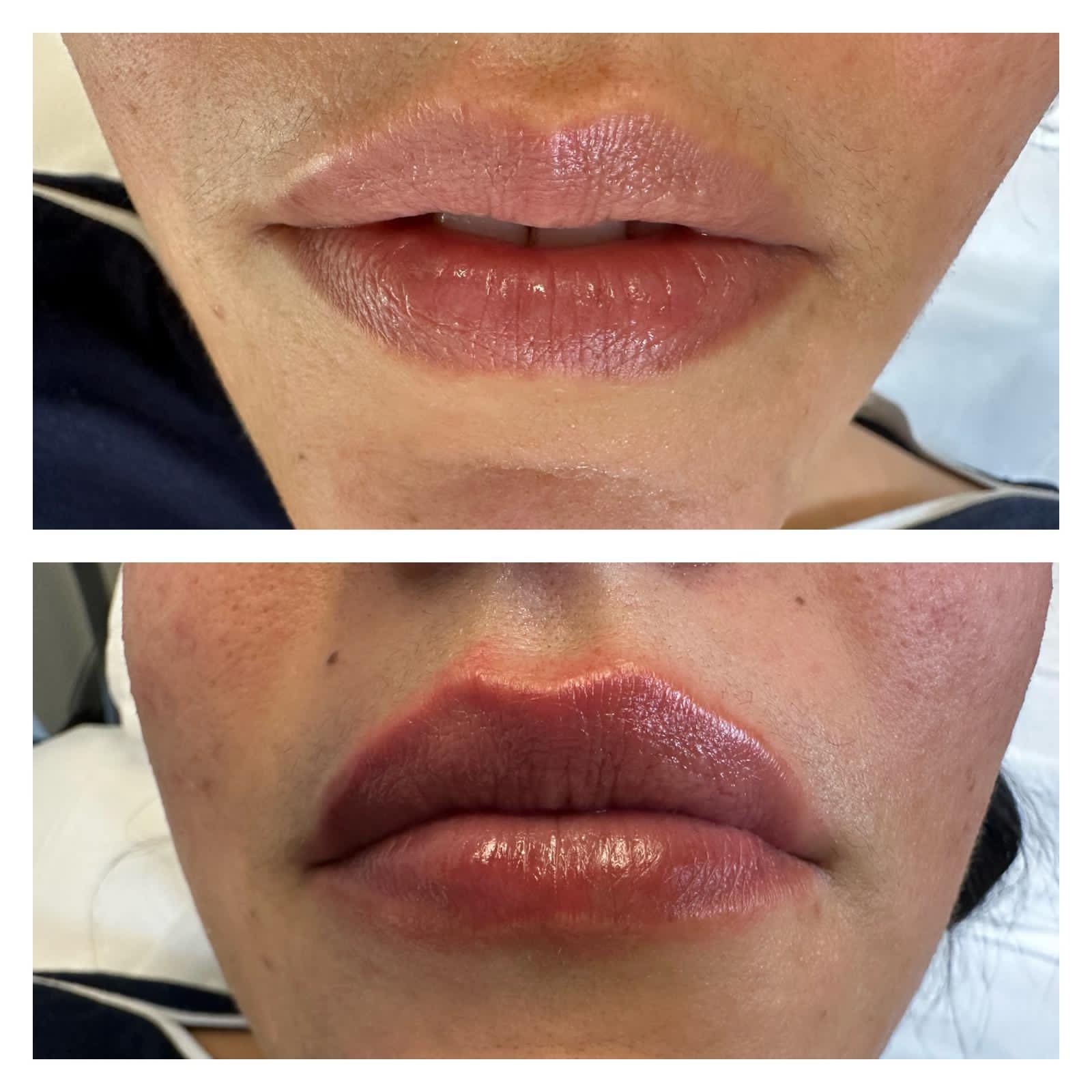 Fotona treatment