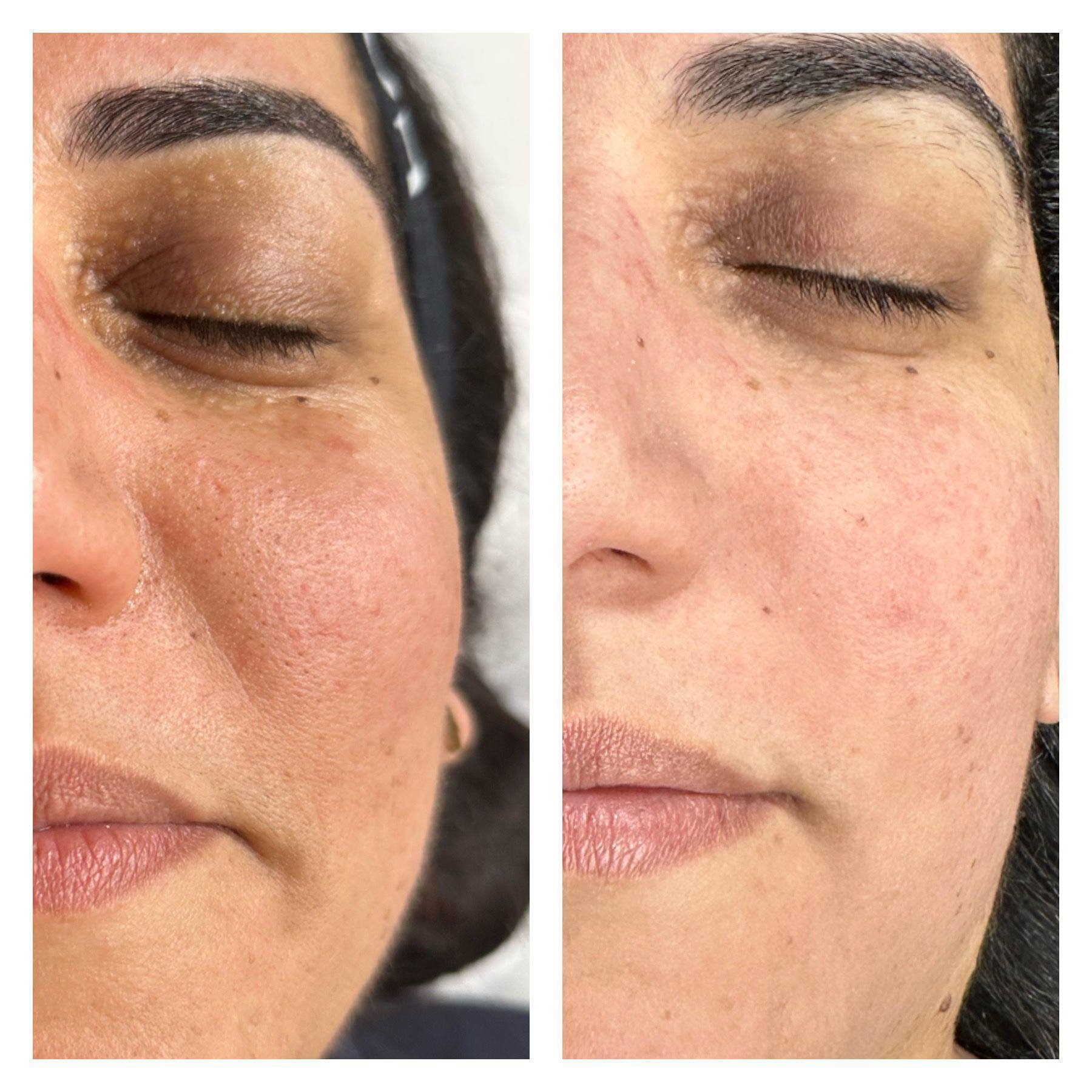 Fotona treatment